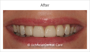 Patient case 1 after